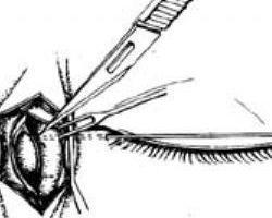 泪囊鼻腔吻合术视频,泪囊鼻腔吻合术操作步骤及要点解析